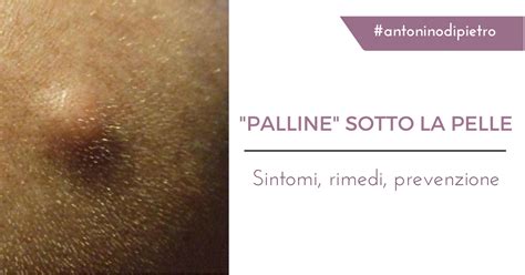 palline sotto pelle